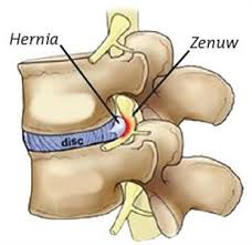 Hernia, spit, rugklachten en behandeling