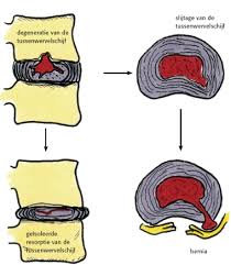 hernia, rugpijn en behandelen